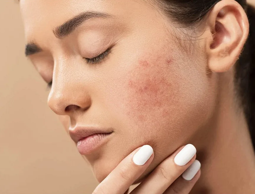 BIO Antiblemish s Levandulí Chodouňskou Roll-on, 10 ml